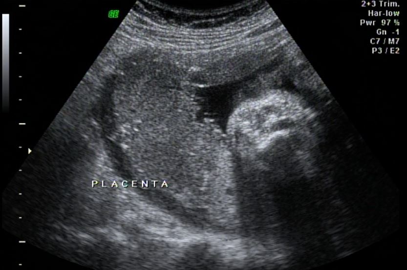 grau da placenta